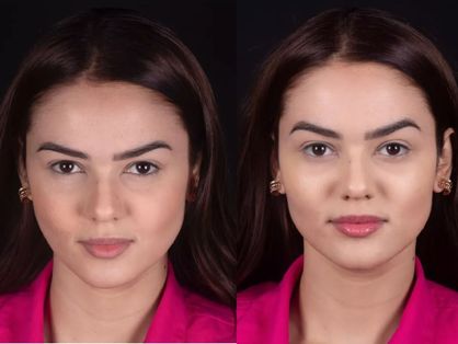 Antes e depois de Eslovênia após harmonização facial