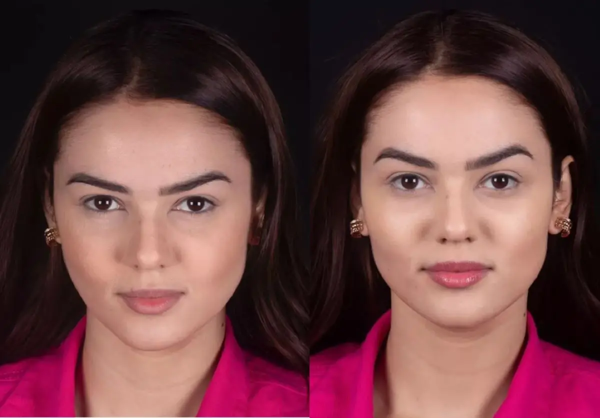 Antes e depois de Eslovênia após harmonização facial