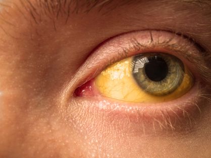 Close-up em olho amarelo de um paciente de hepatite aguda grave