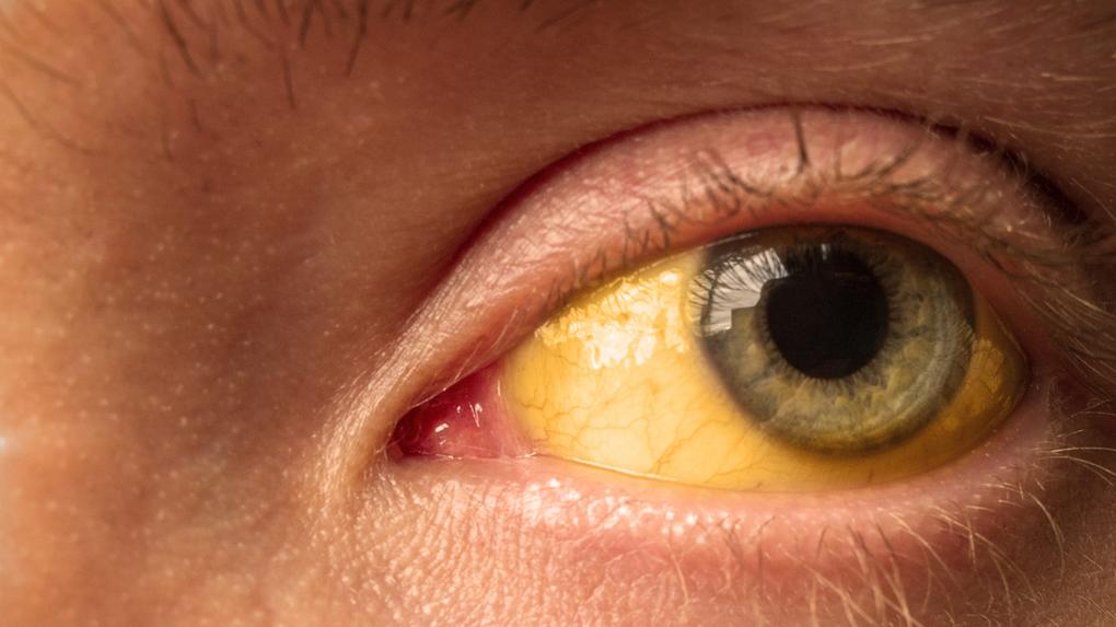 Close-up em olho amarelo de um paciente de hepatite aguda grave