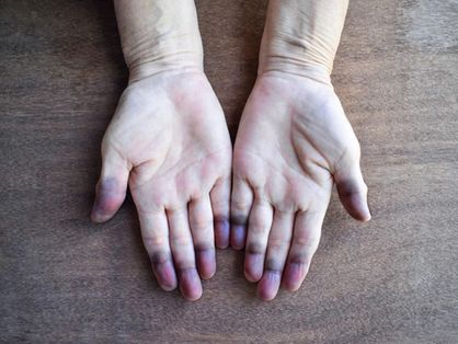 Mãos de paciente com cianose