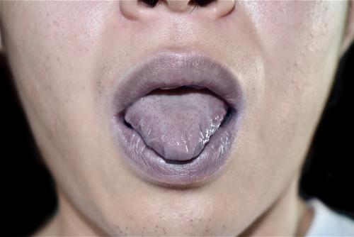 Sintoma de cianose nas mucosas