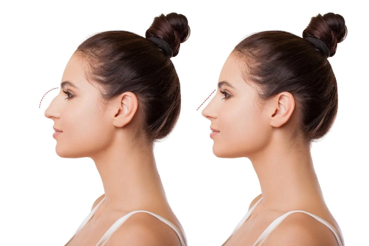 Rinoplastia pode realizar mudanças na estrutura do nariz