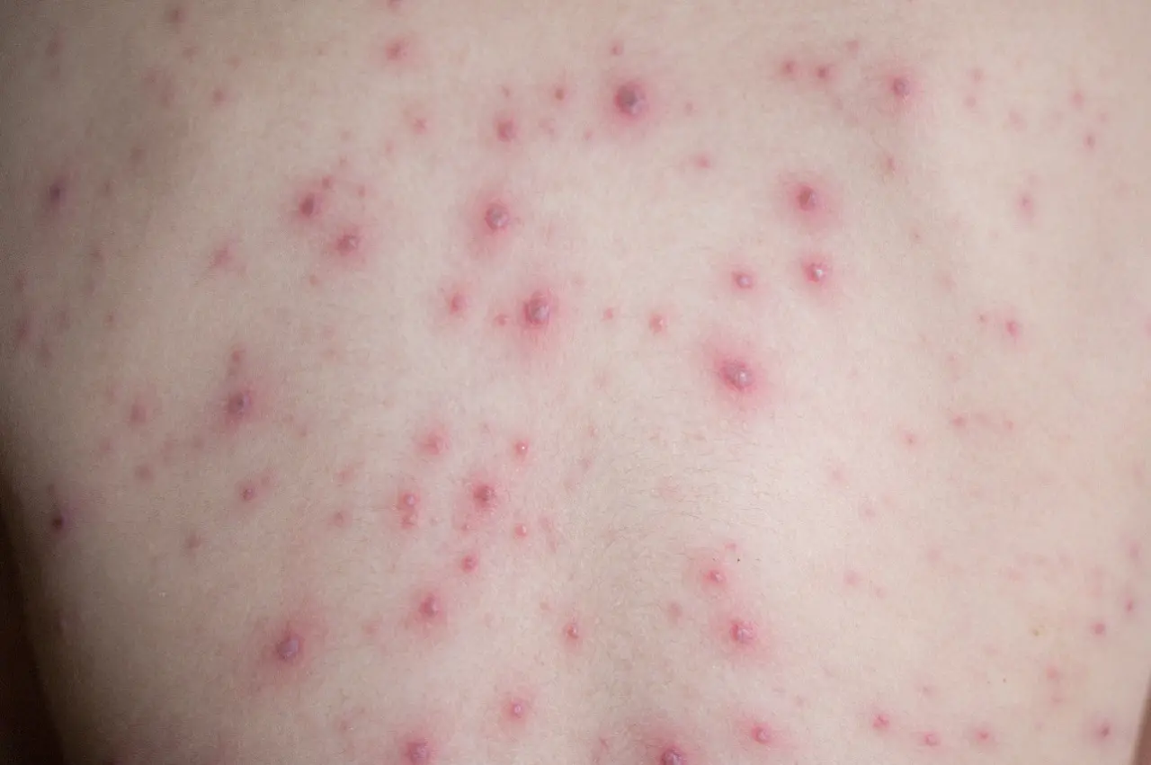 varíola dos macacos doença confirmada na américa latina