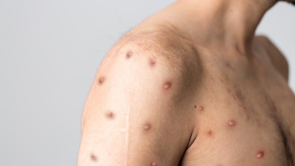 Corpo com a doença varíola