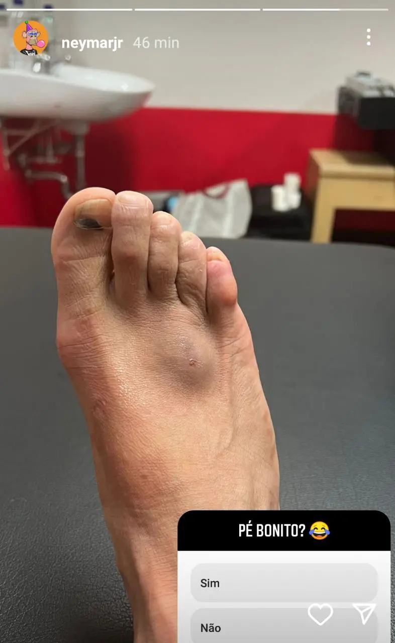 Imagem mostra um pé machucado