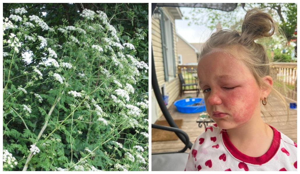 Menina envenenada por planta