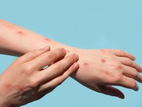 Mãos de pessoa infectada com varíola dos macaco