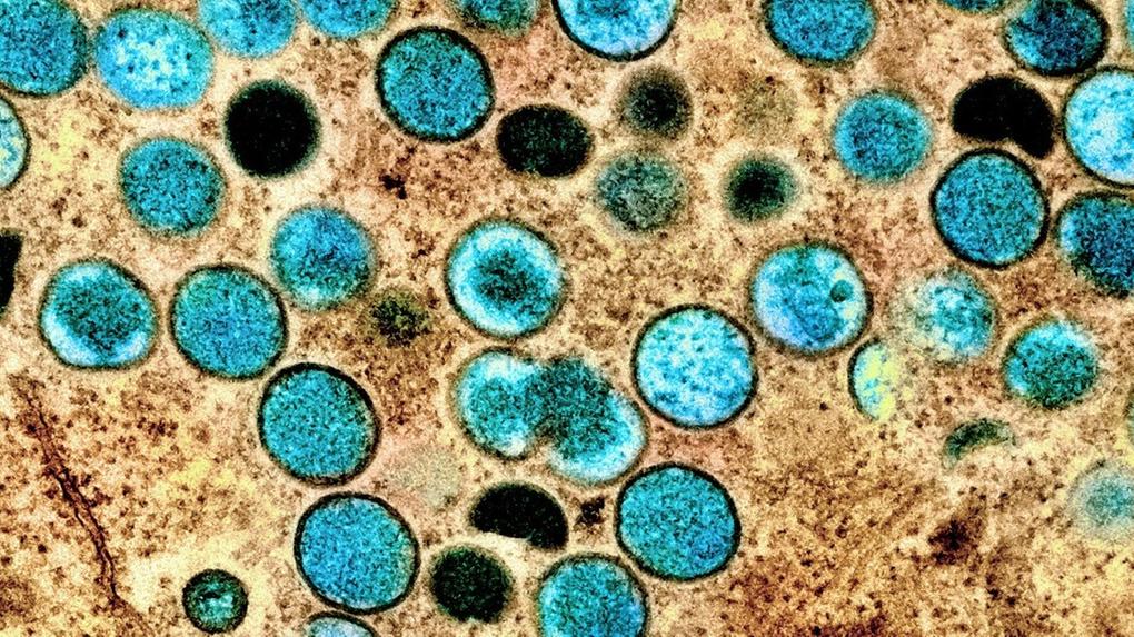 varíola dos macacos morte no brasil primeira no mundo