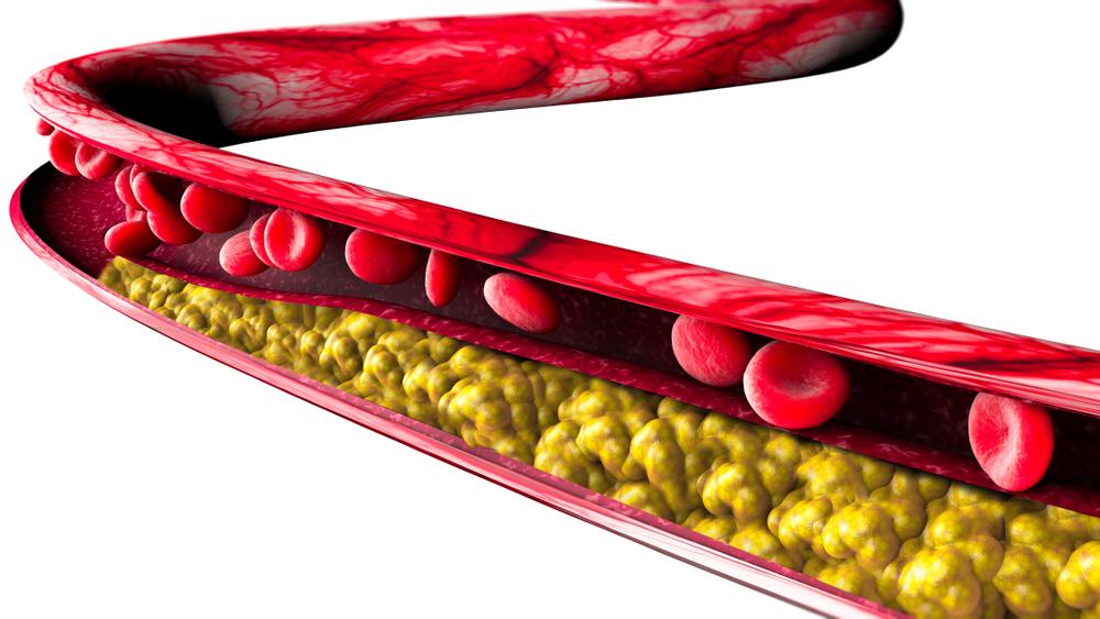Ilustração mostra como as placas de gordura estreitam uma veia.