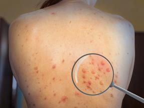 Infecção pelo vírus da varíola dos macacos (monkeypox virus) na pele de uma mulher