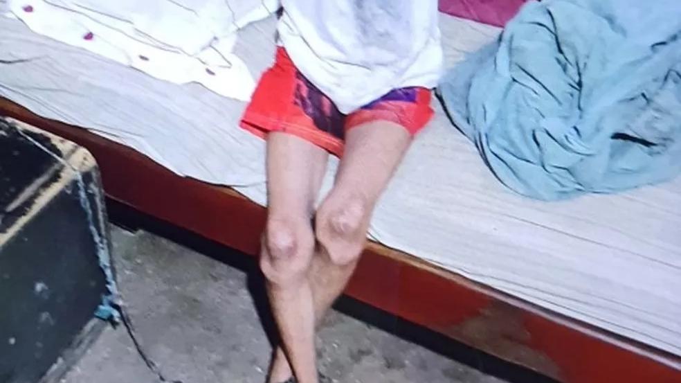 Foto mostra as pernas de um jovem acorrentadas, com sinais evidentes de magreza extrema