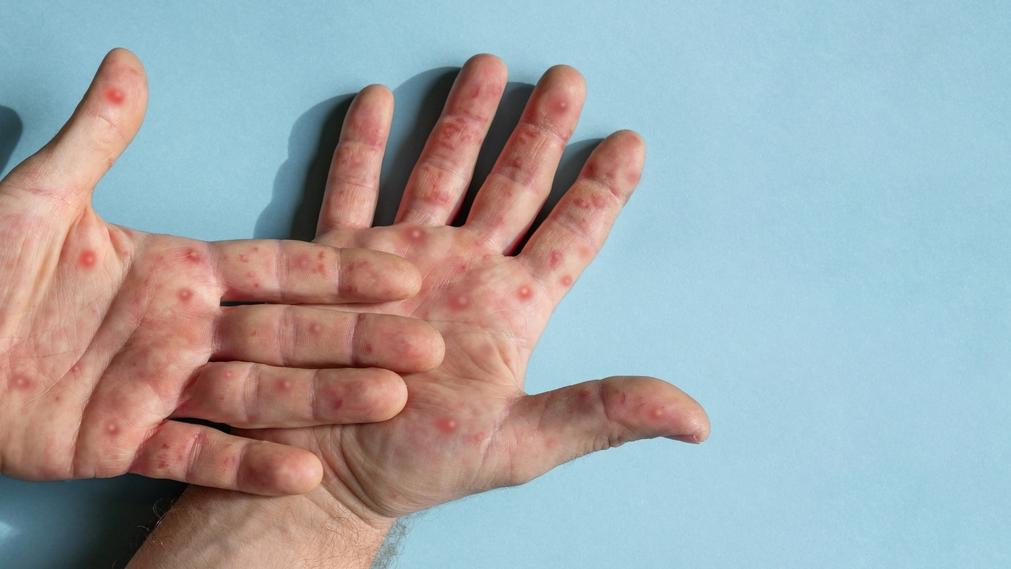 Mão de uma pessoa com varíola dos macacos