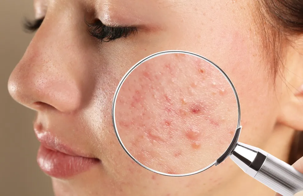 Aplicada no rosto, a babosa é utilizada, também, no tratamento da acne.