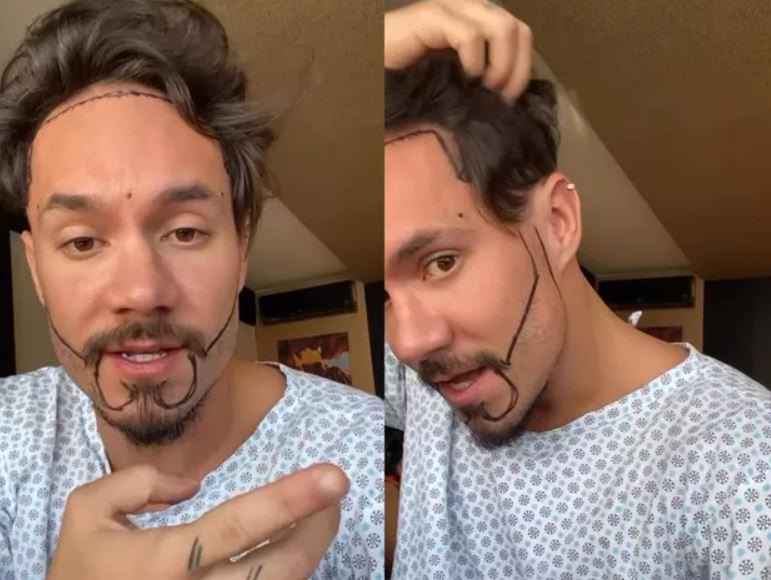Eliezer em cirurgia para transplante de cabelo e barba