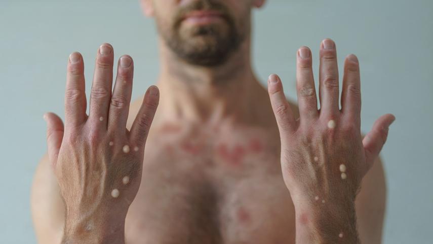 Homem sem blusa exibe lesões causadas pela varíola dos macocos em fundo claro