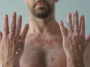 Homem sem blusa exibe lesões causadas pela varíola dos macocos em fundo claro