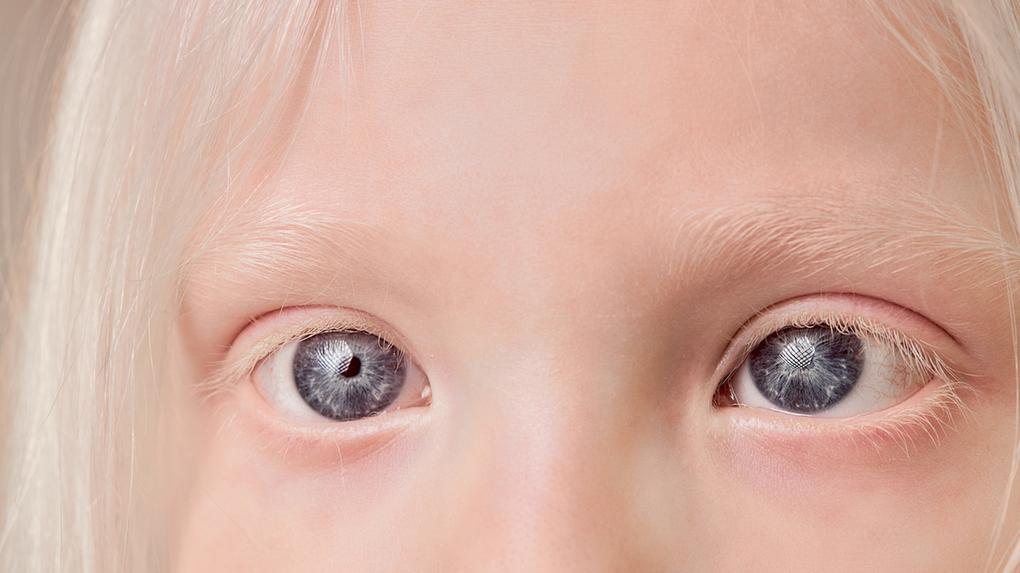Close-up de rosto de criança albina