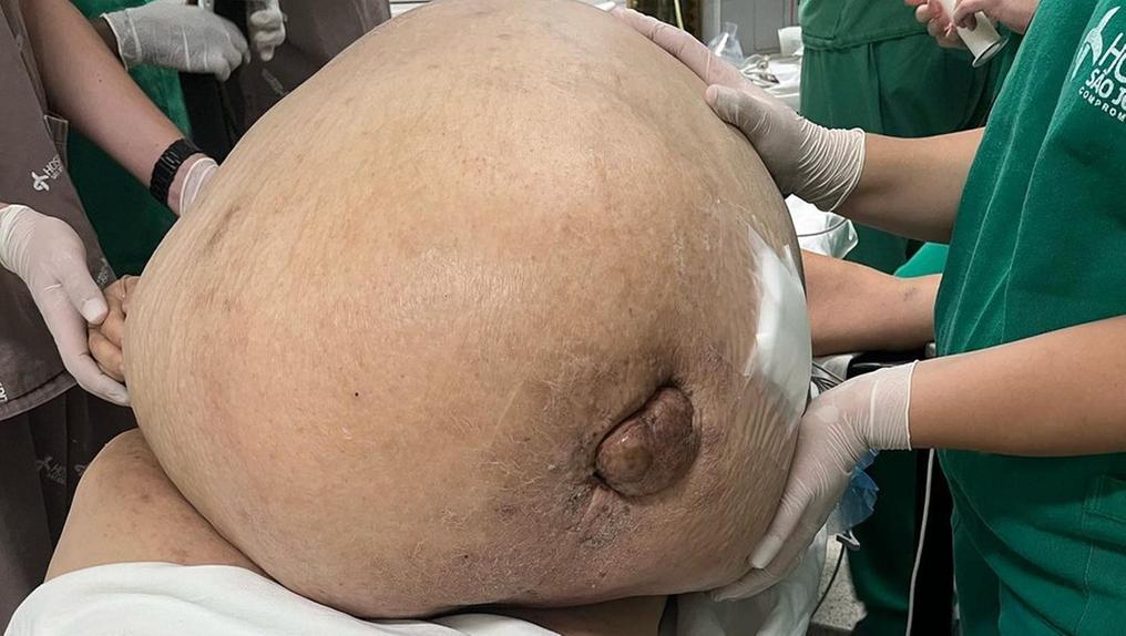 Imagem mostra barriga de paciente antes de cirurgia que retirou tumor de 46 kg em Itaperuna