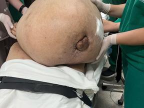 Imagem mostra barriga de paciente antes de cirurgia que retirou tumor de 46 kg em Itaperuna