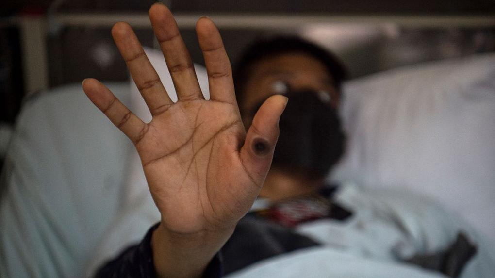 Mão de paciente com lesão causada pela varíola dos macacos