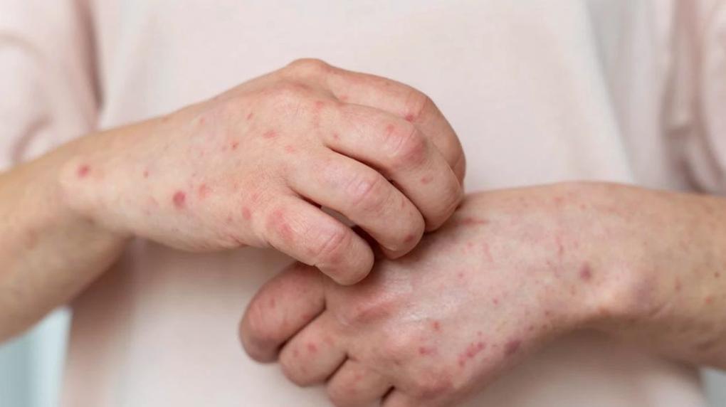 mãos de pessoa com lesões de monkeypox