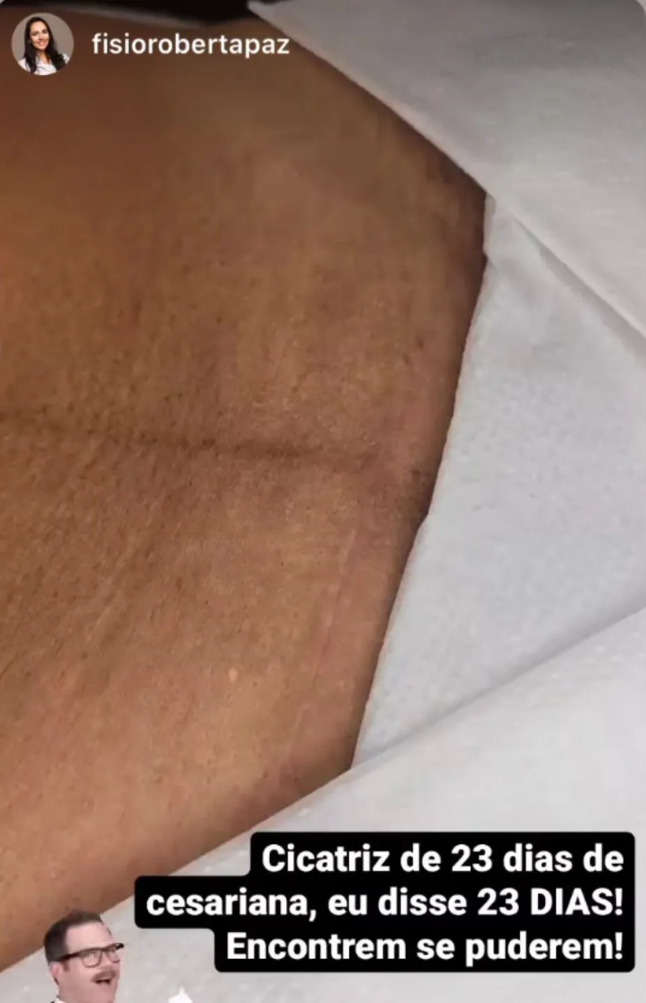 Fisioterapeuta compartilhou marca quase invisível de cicatriz da cesariana.