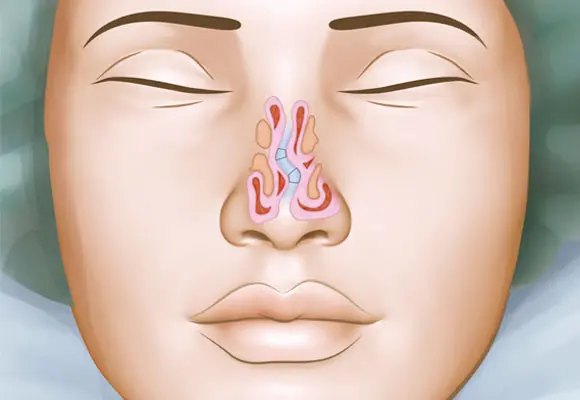 Em vista da pressão causada pelo desvio, o indivíduo também pode sofrer com constantes dores de cabeça e enfrentar dificuldades para praticar exercícios,