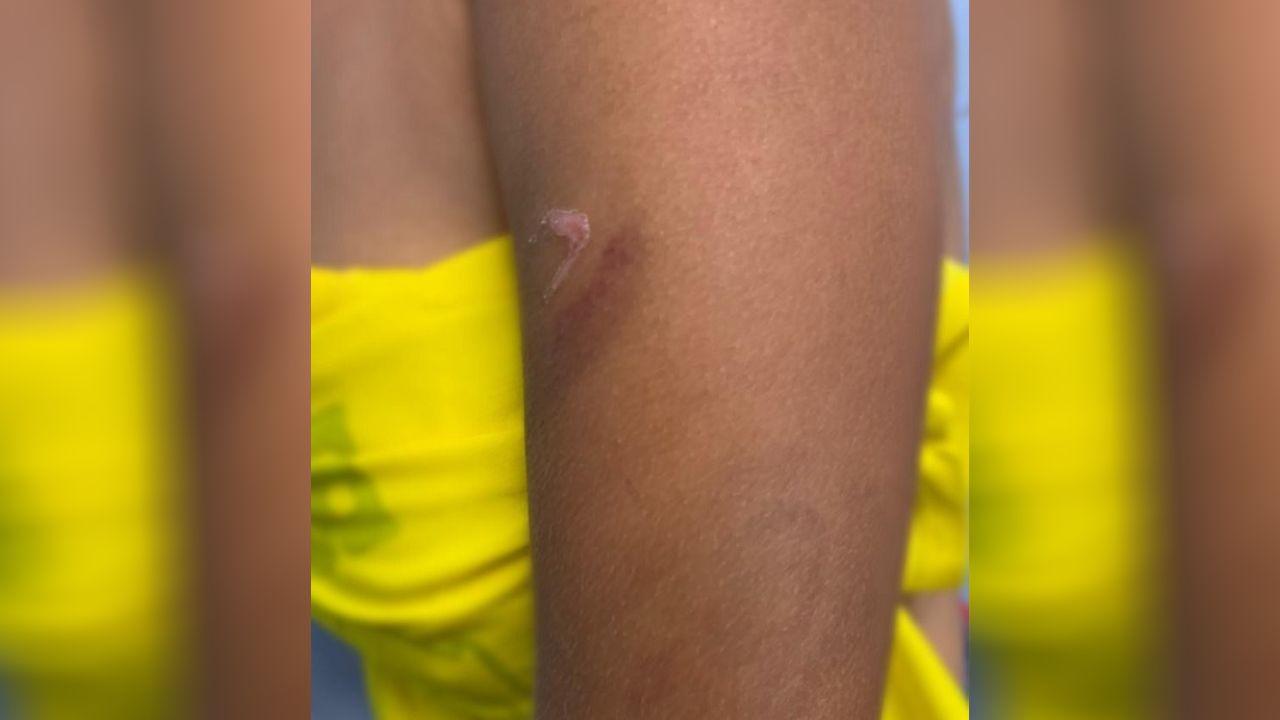 Hematoma em adolescente torturada pelos pais em Aurora, interior do Ceará