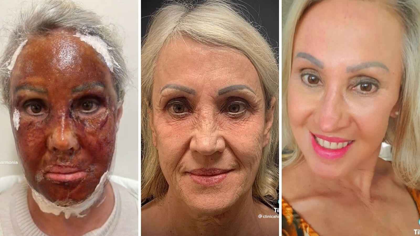 Legenda: Clínica compartilhou antes e depois de paciente após peeling de fenol Foto: Reprodução/TikTok