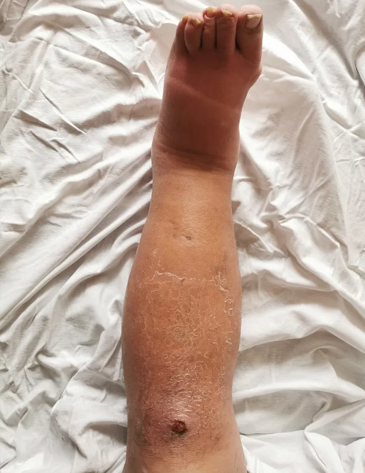 Em alguns casos, os membros podem inchar bastante e podem surgir erupções cutâneas.