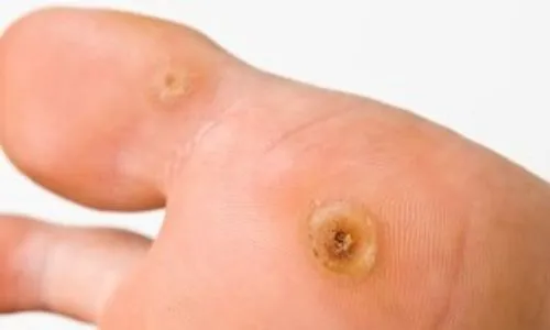 A tungíase é caracterizada por um nódulo esbranquiçado com um ponto escuro no meio.