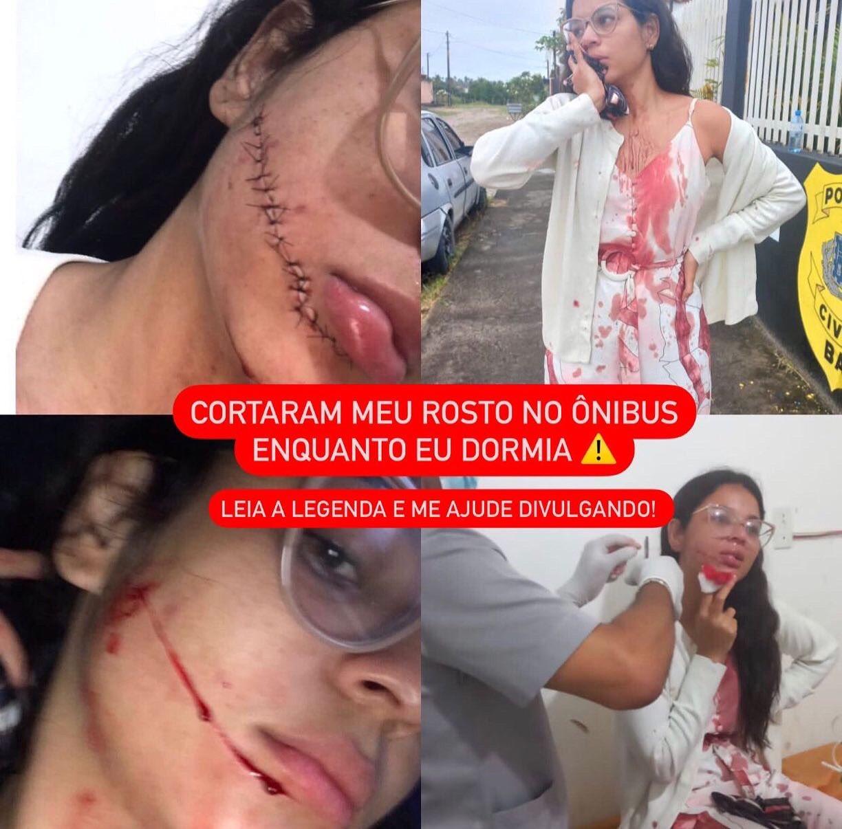 Rosto ponteado de jovem atacada enquanto dormia durante viagem de ônibus na Bahia