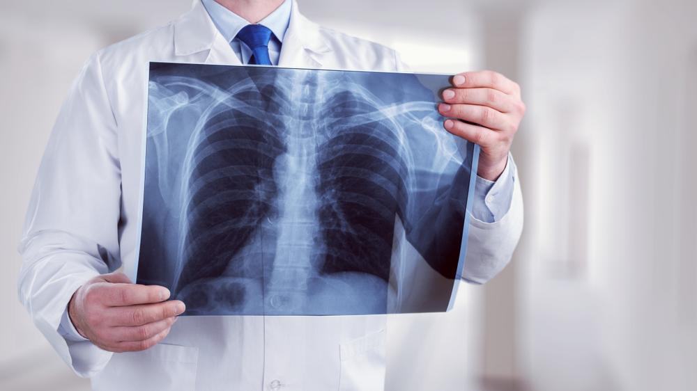 Médico segura o raio-x de um pulmão humano