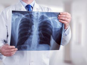 Médico segura o raio-x de um pulmão humano