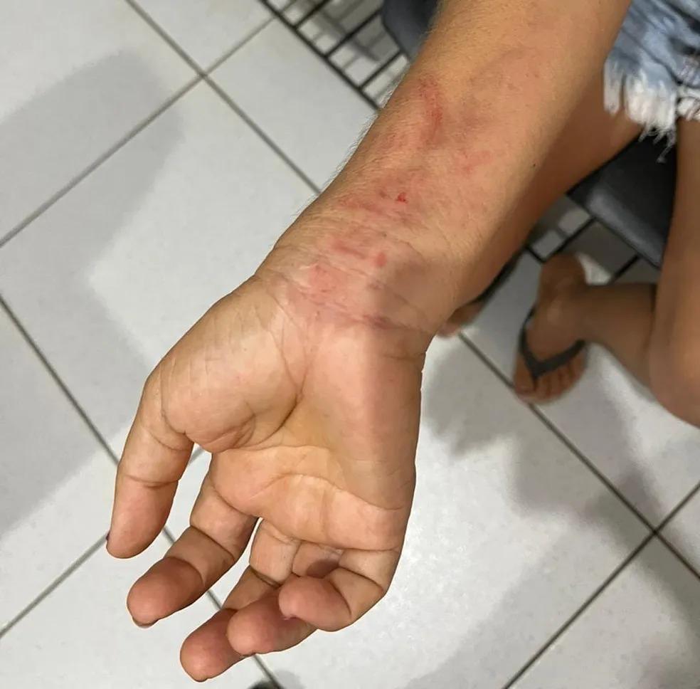 Mulher expõe braço machucado