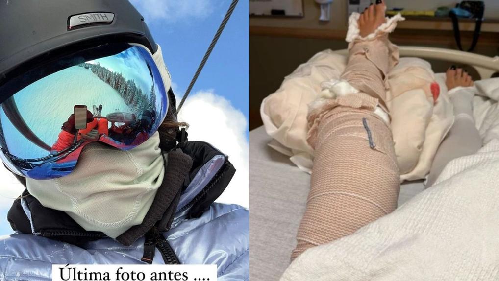 Luciana Gimenez posta fotos após acidente de esqui