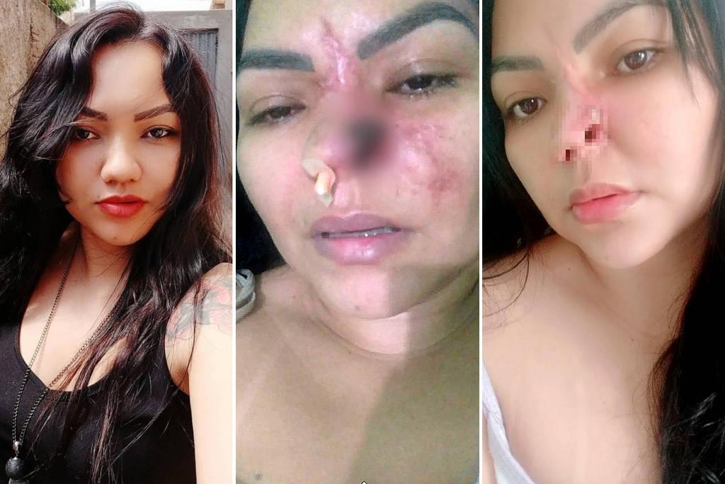 Mulher perde parte do nariz após cirurgia estética: “É assustador