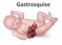 Ilustração mostra como é uma gastrosquise