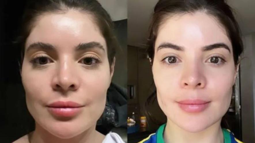 Jojo Todynho realiza procedimento no rosto; veja antes e depois