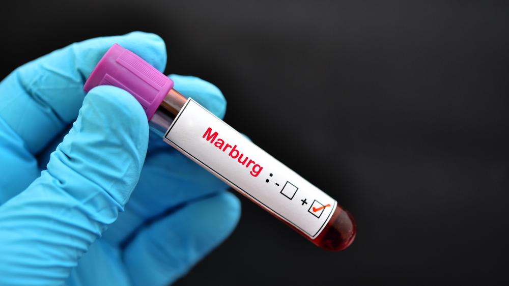 Mão com luva azul segura frasco de amostra de sangue positivada para o vírus Marburg