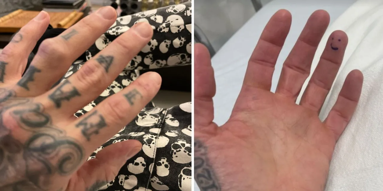 Travis Barker lesiona dedo em ensaio e passa por cirurgia