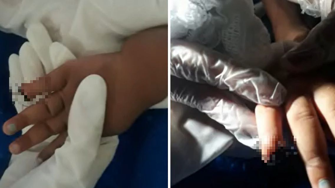 Enfermeira amputa parte do dedo de bebê por descuido em hospital do RJ