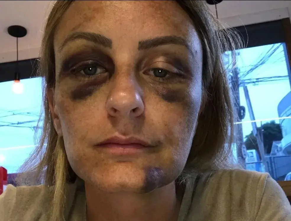 Imagem da notícia: Surfista brasileiro que deu soco em norte-americana é acusado de agressão por ex-namorada