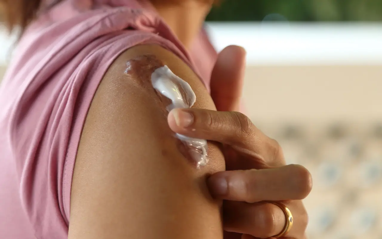 Paciente aplica creme em queloide localizado na região do ombro
