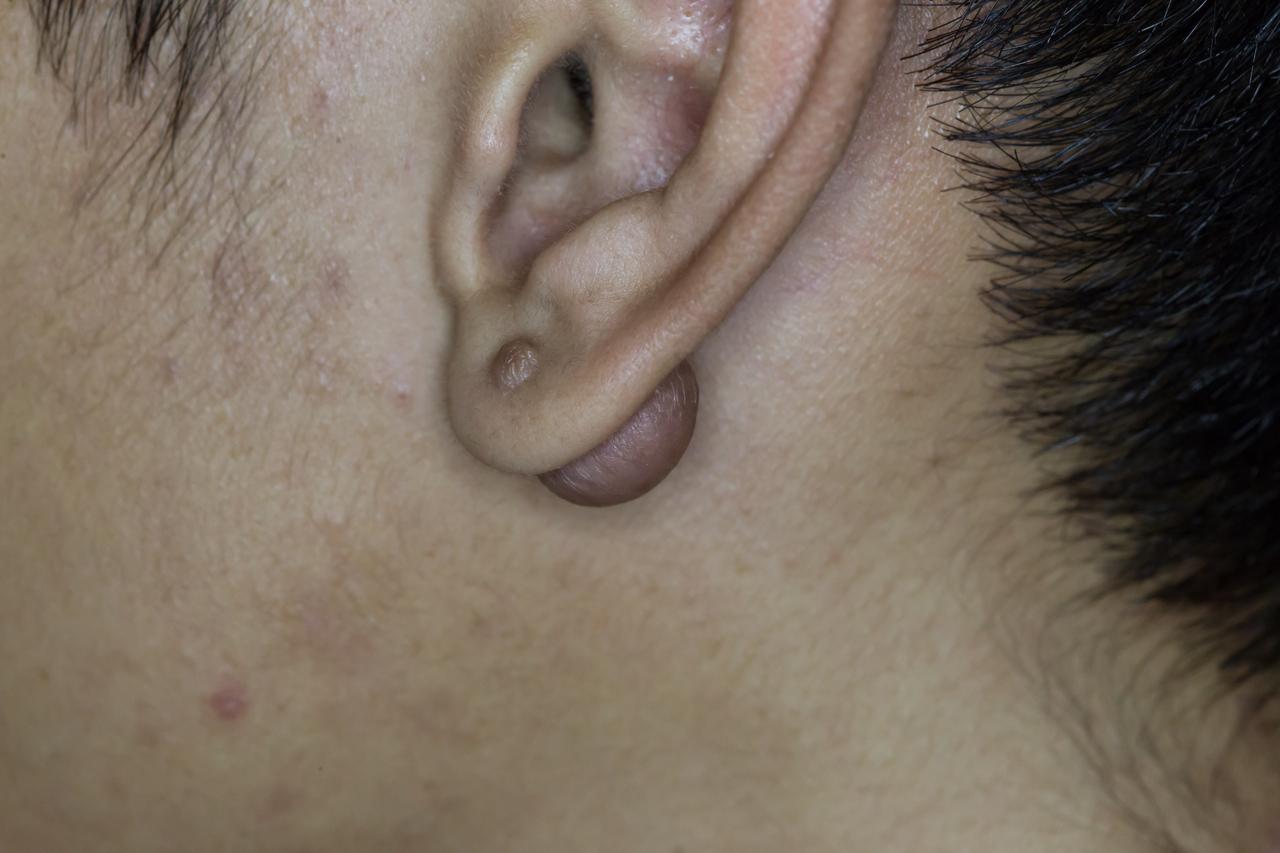 Queloide na região da orelha de paciente