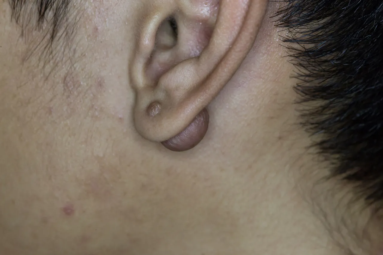 Furo para brinco e piercing podem gerar queloides