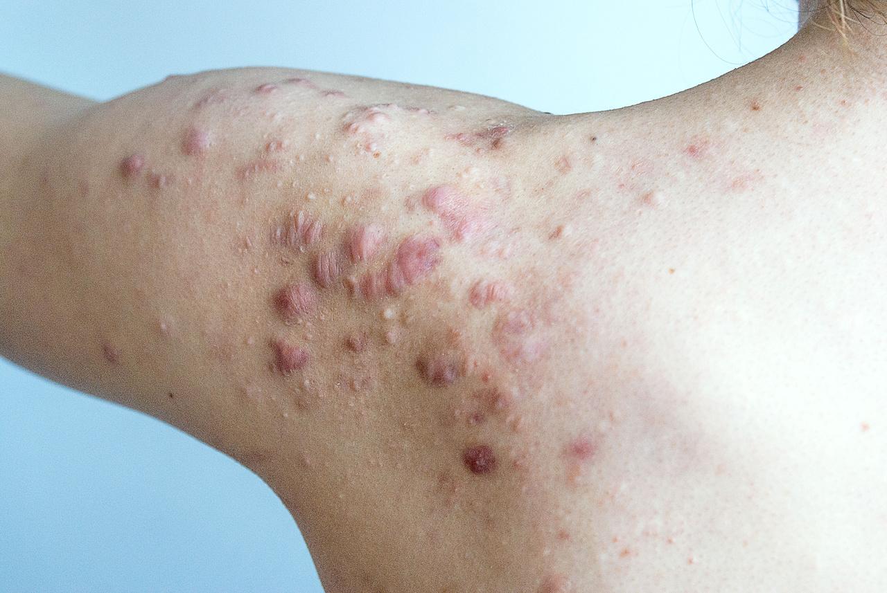 Queloides provocados por acnes na região do ombro de paciente
