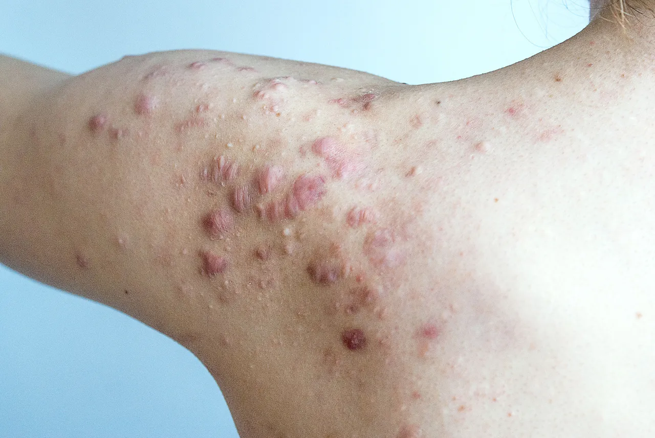 Acnes podem provocar marcas de queloide