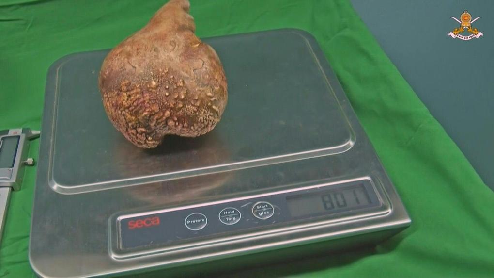 Maior pedra nos rins é extraída por médicos no Sri Lanka